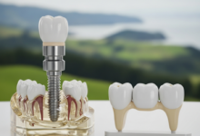 A close-up, photorealistic comparison of a dental implant model and a dental bridge model. The implant shows a titanium post, abutment, and crown emerging from a conceptual bone structure. The bridge displays three connected porcelain teeth. The background is an extremely blurred, out-of-focus green landscape, hinting at New Zealand. No text is visible.